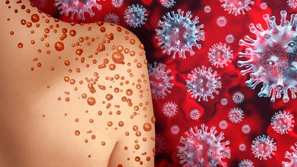 جدري القردة لا يزال حالة طوارئ عالمية