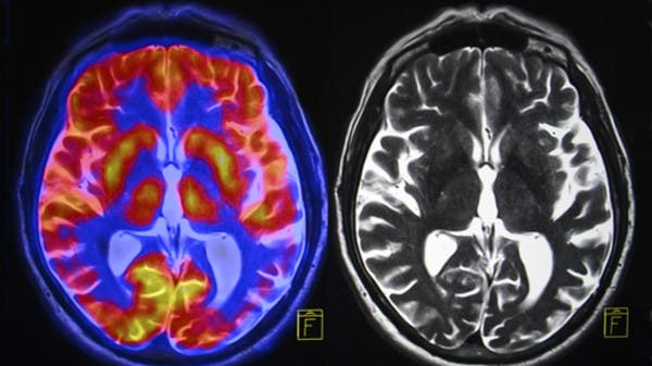 ظهور علامات شيخوخة على المراهقين.. والسبب كورونا