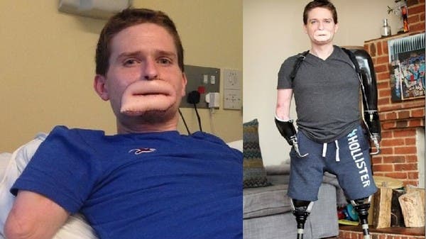 بكتيريا مرعبة فتكت بأطفال وبترت أطراف رجل جعلته بفم غريب