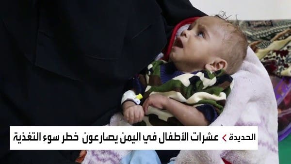 مستشفى بالحديدة يستقبل مئات اليمنيين من المصابين بسوء التغذية