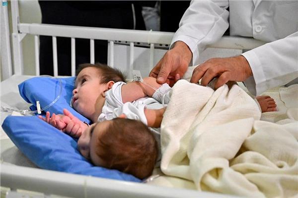 بدء مراحل فصل التوأم العراقي بالرياض.. صور