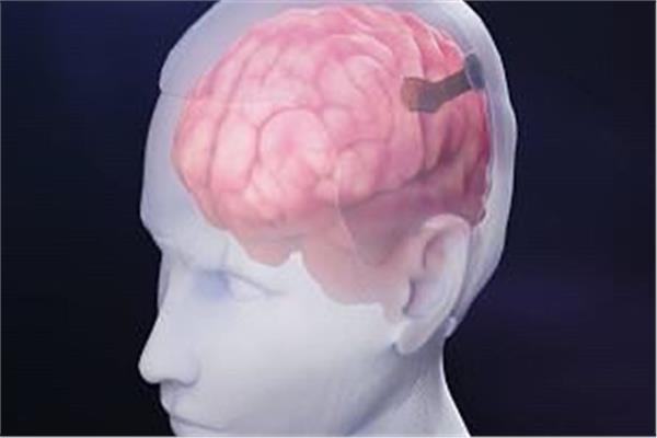 تطوير شريحة دماغية تسمح باستخدام وسائل التواصل الاجتماعي من خلال العقل