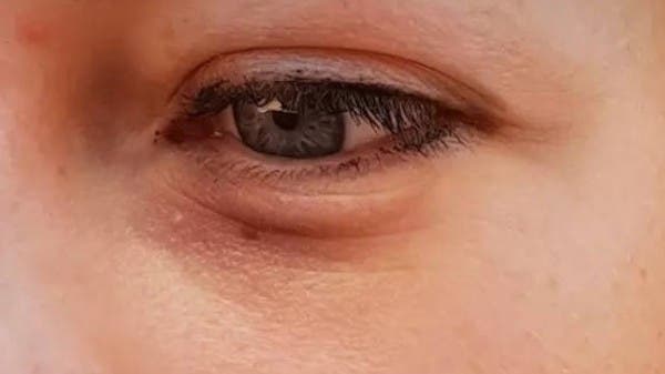 10 عناصر غذائية تكافح الهالات السوداء تحت العينين