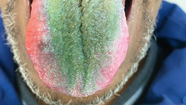 ما السر؟.. تحول لسانه للأخضر ونبت عليه الشعر