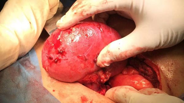 نقلة تاريخية.. نجاح أول عملية زرع كلية خنزير في جسم إنسان