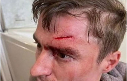 لاعب انكليزي سابق يكشف مساوىء مرضه النادر!