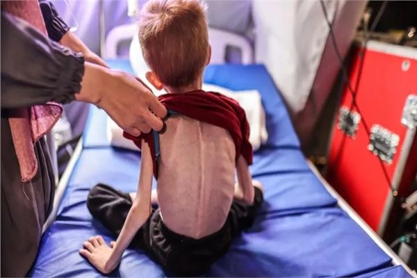 منظمة الصحة العالمية: 112 طفلا يدخلون مستشفيات غزة يوميا بسبب «سوء التغذية»