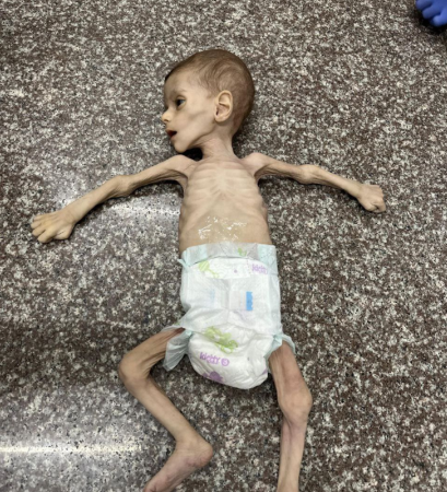 وفاة طفل بسبب المجاعة وسوء التغذية في قطاع غزة-الحياة الجديدة