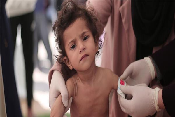 الأمم المتحدة: سوء التغذية الحاد بين الأطفال بغزة وصل «أعلى مستوى»
