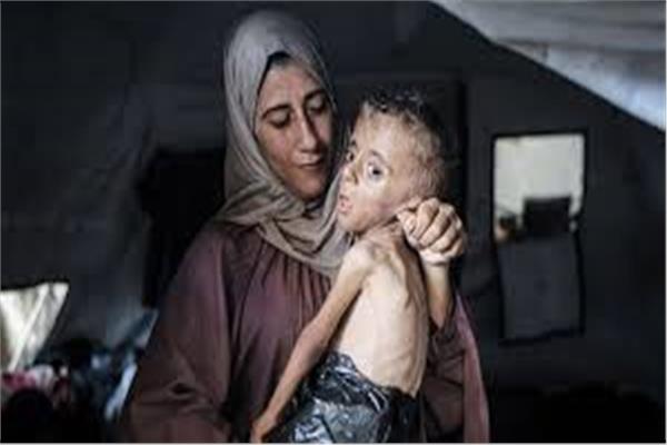 3 وفيات جديدة نتيجة المجاعة وسوء التغذية بغزة خلال الـ24 ساعة الماضية