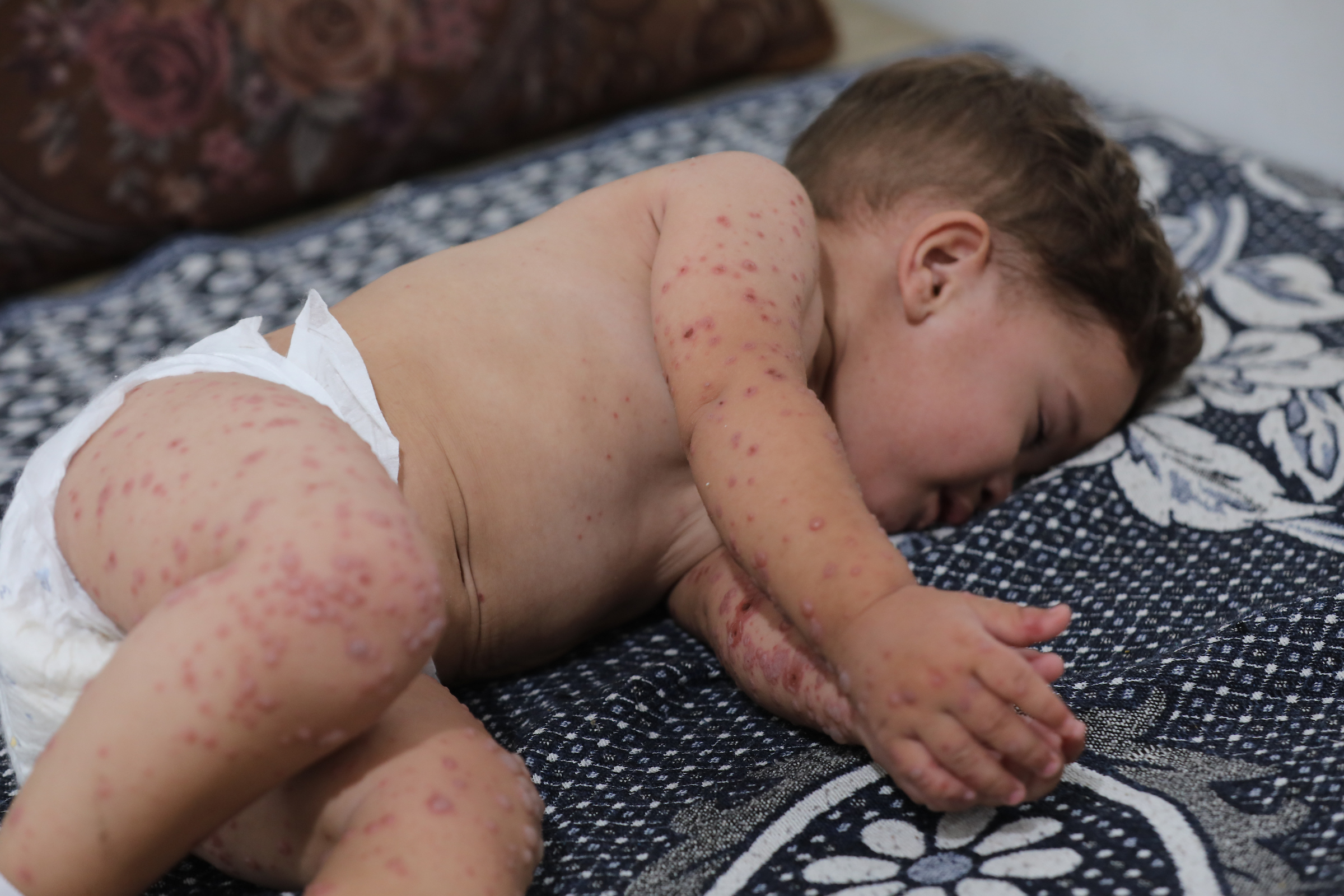 من الطفح إلى الموت.. أوبئة جلدية تلتهم أطفال غزة-الحياة الجديدة