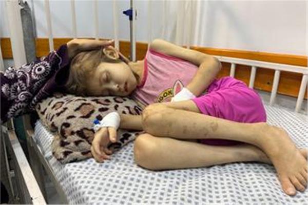 مسئول كبير بالأمم المتحدة: سوء التغذية في غزة ستمتد آثاره لأجيال قادمة