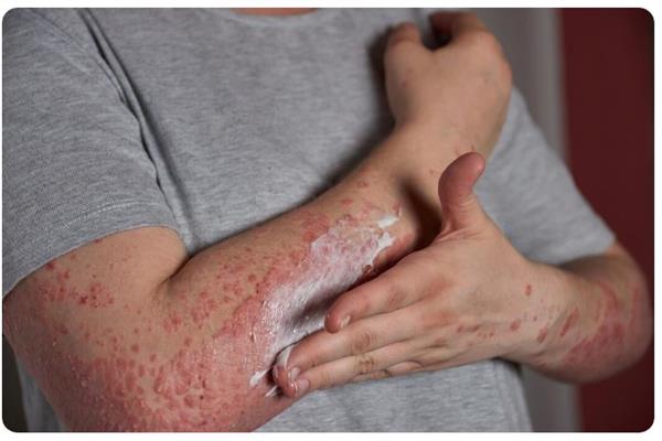 أول وفاة مأساوية بسبب حساسية اللحوم المرتبطة بلدغات القراد في نيوجيرسي